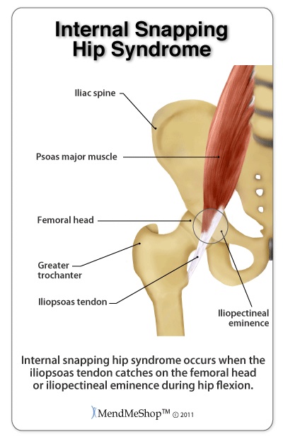 internal-snapping-hip-syndrome